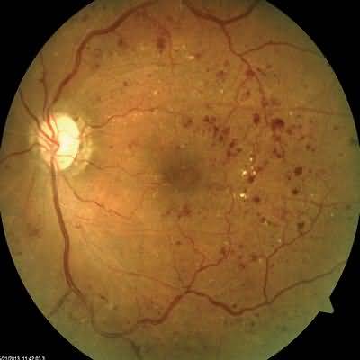 Diabetic retinopathy is broadly classified as nonproliferative